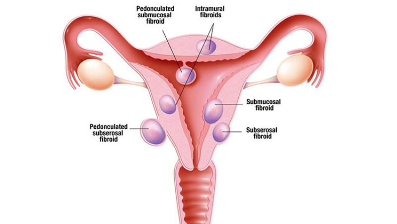 Uterine Hemorrhage